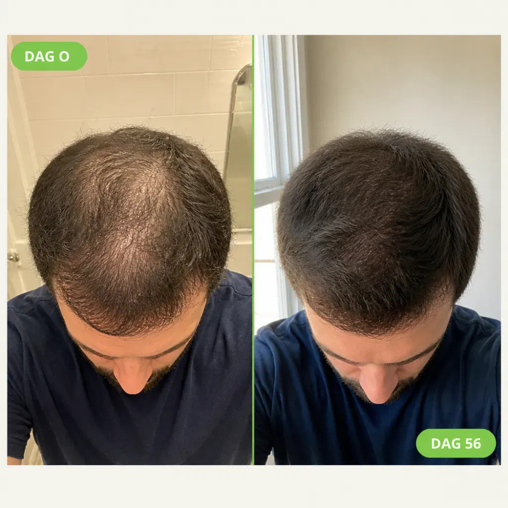 RootBoost™ | Start med hodebunnen for fyldigere hår