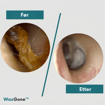 WaxGone™ | Fjern ørevoks skånsomt uten bomullspinner