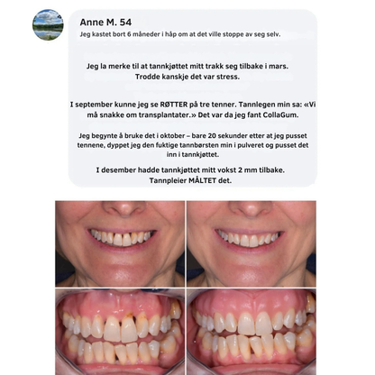 CollaGum™ | Styrk tannkjøttet ditt innenfra og bevar ditt naturlige smil