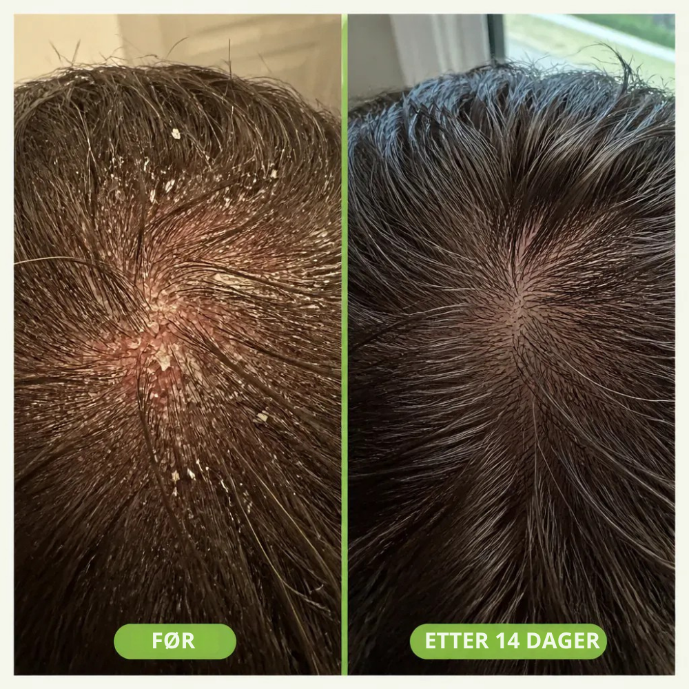 RootBoost™ | Start med hodebunnen for fyldigere hår