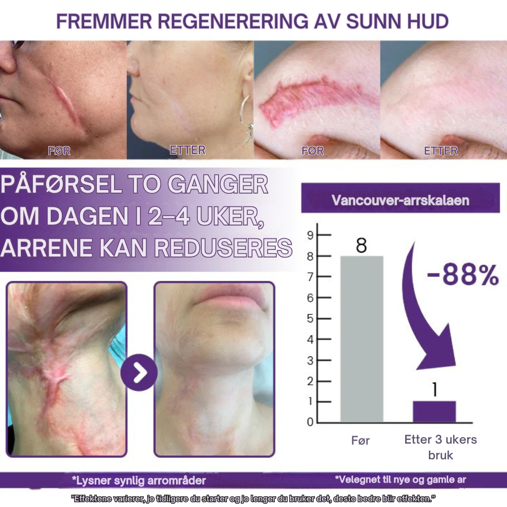 RegenScar™ | Gjør synlige arr glattere og mindre fremtredende