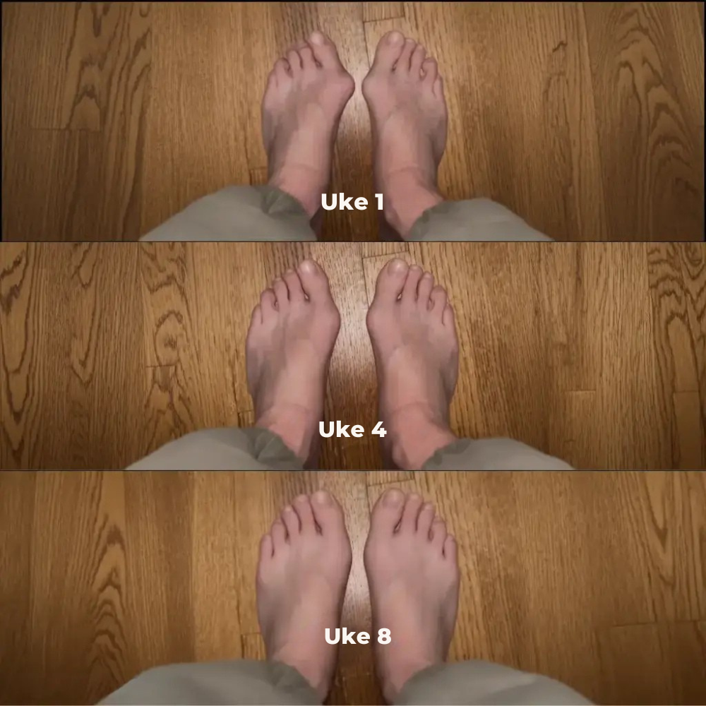 ToeAlign™ | Gjenopprett fotens naturlige balanse uten inngrep