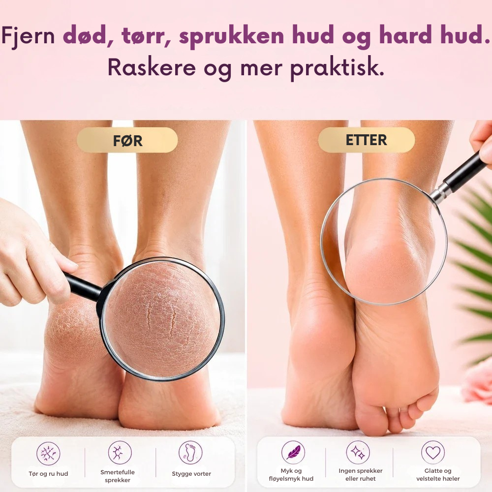 PediSmooth™ | Elektrisk fotpleie for myke, velpleide hæler hjemme