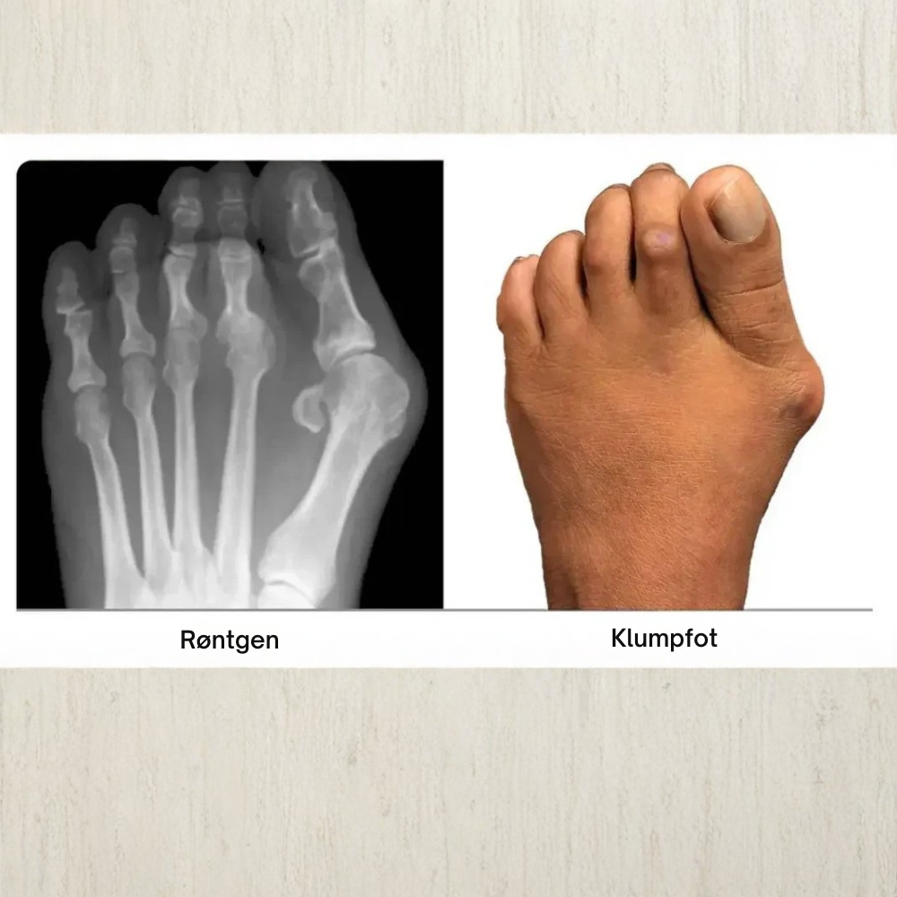 ToeAlign™ | Gjenopprett fotens naturlige balanse uten inngrep